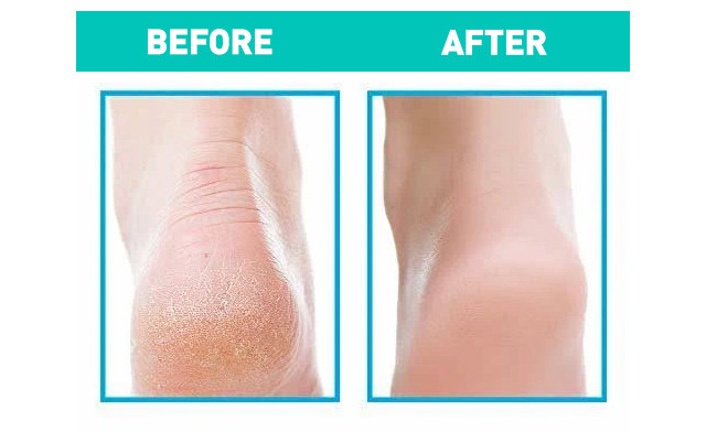 Image of $15.95 for a Fresh Feet Foot Scrubber (a $29.99 Value)