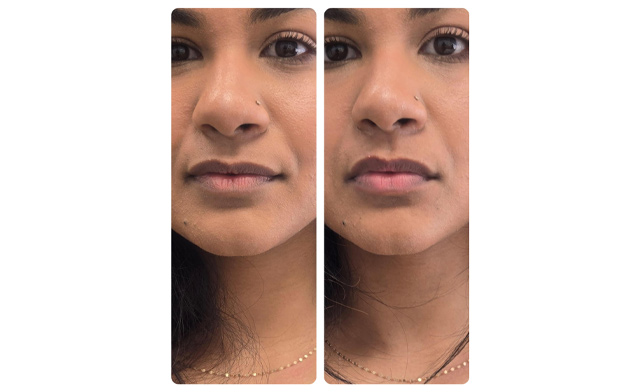 Image of $19 for a Non-Injection RF Lip Plumping Treatment at Divine Beauty