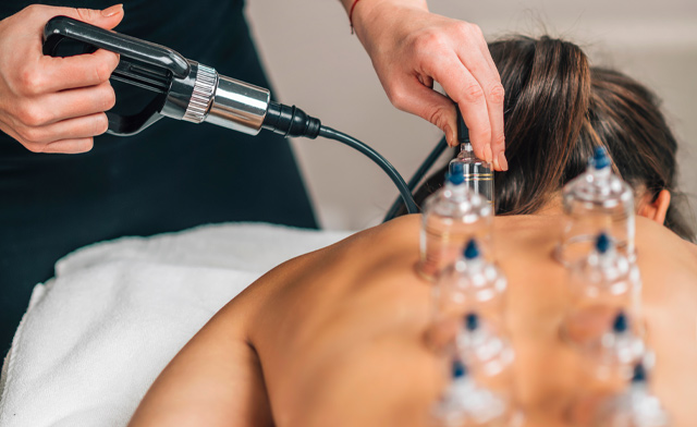 Image of $48 & Up for Cupping, Acupuncture, Gua Sha & Combo Treatments