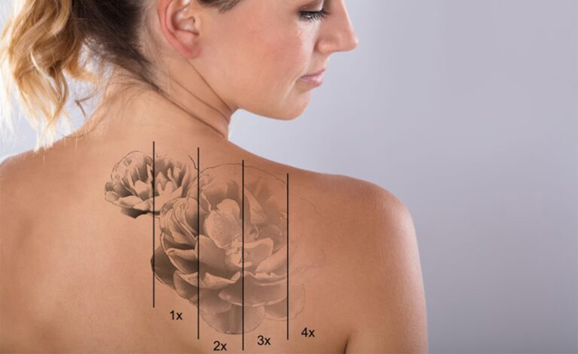 Image of $45 & Up for One Tattoo Removal Session at BeautiFly Medi Spa