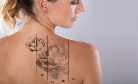 $45 & Up for One Tattoo Removal Session at BeautiFly Medi Spa