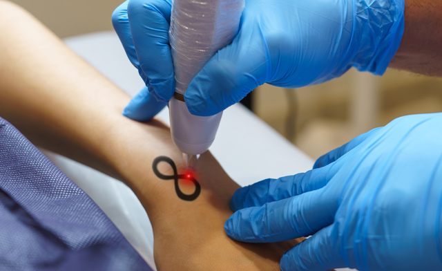Image of $45 & Up for One Tattoo Removal Session at BeautiFly Medi Spa
