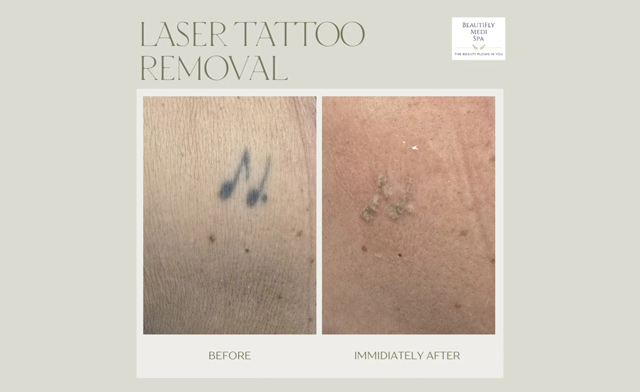 Image of $45 & Up for One Tattoo Removal Session at BeautiFly Medi Spa