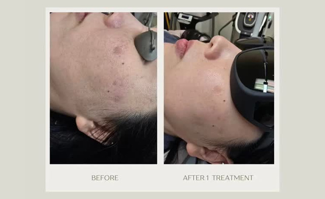 Image of FLASH SALE! $20 for an IPL Facial at BeautiFly Medi Spa