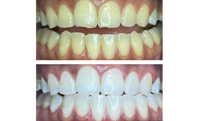 Image of $39 for a 1-Hour Teeth-Whitening Session at Summer Sun Salon (a $99 Value)