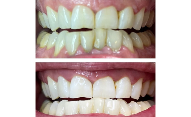 Image of $39 for a 1-Hour Teeth-Whitening Session at Summer Sun Salon (a $99 Value)