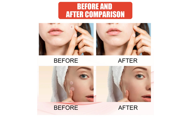 Image of $39 for 720 Transparent Medical-Grade Pimple Patches (a $69.99 Value)