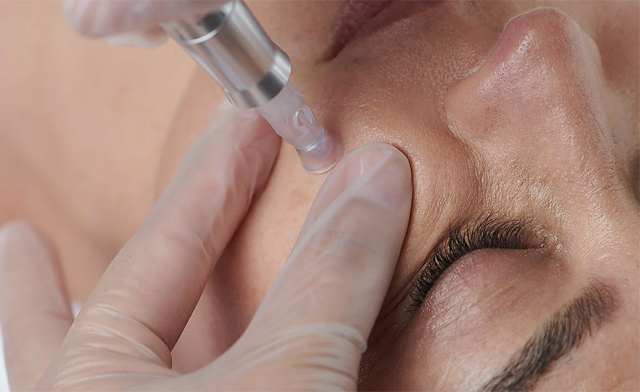 Image of $49 for a 30-Minute Nano Infusion Treatment from BeautiFly Medi Spa