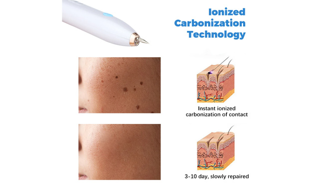 Image of $29.95 for a Blemish Removal Plasma Pen (a $53.08 Value)