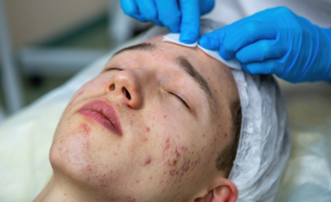 $39 for a Laser Acne Facial Treatment at A&A Medical Aesthetics