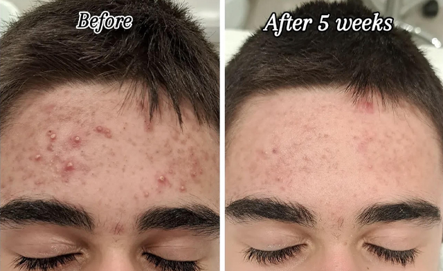Image of $39 for a Laser Acne Facial Treatment at A&A Medical Aesthetics