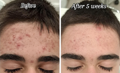 $39 for a Laser Acne Facial Treatment at A&A Medical Aesthetics