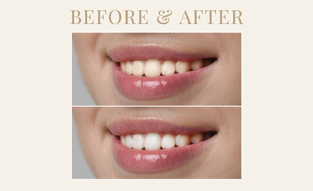 Image of $69 for a 1-Hour Non-Peroxide Teeth Whitening + a $20 Gift Certificate at The Glossy Garden