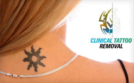 Image of $49 for a Laser Tattoo Removal Treatment at Anti-Aging Clinic (a $270 Value) -  Choose from Locations in Toronto and Newmarket 