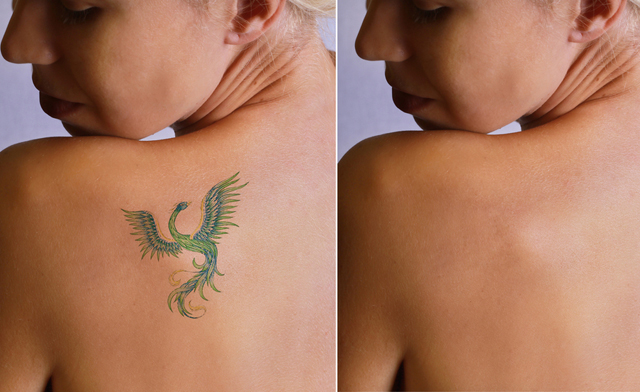 Image of Up to 57% off for Laser Tattoo Removal from Polished Nails & Esthetics