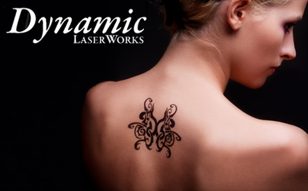 Image of Up to 85% off Tattoo Removal at Dynamic Laser Works (2 Options)